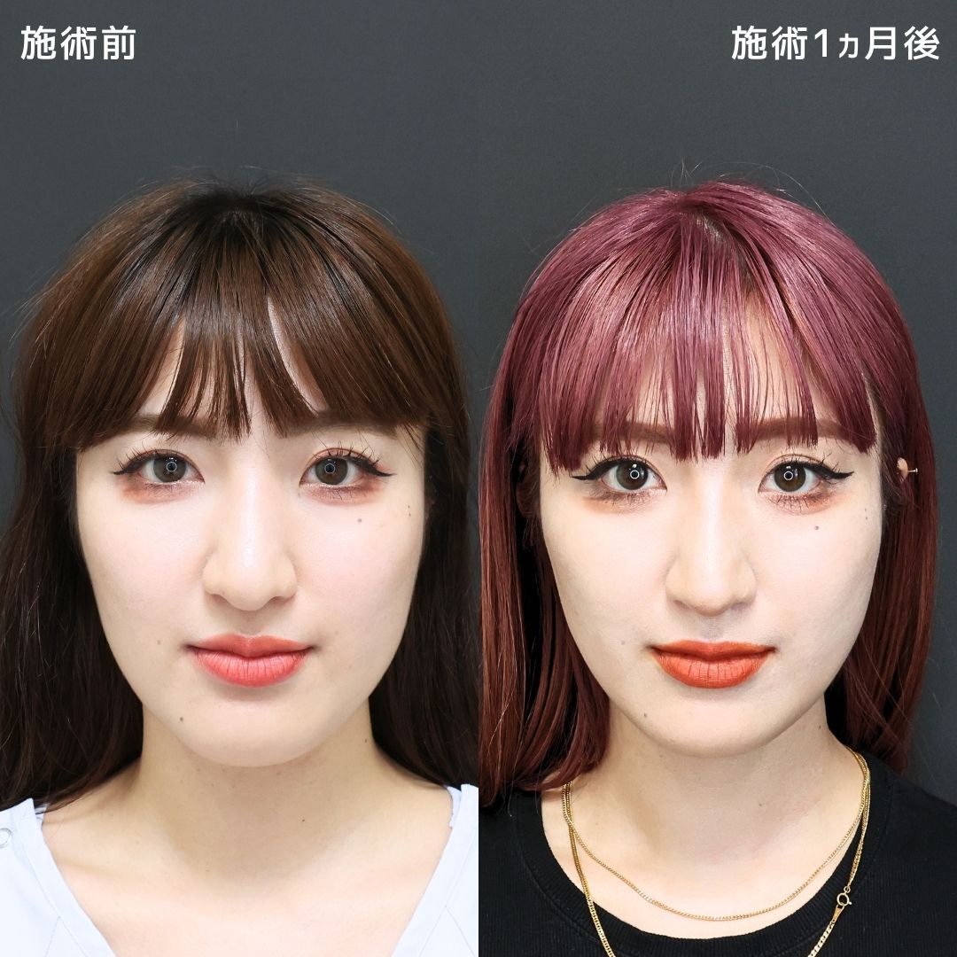 TAC式 ツヤ肌コラーゲンリフト®/Lラインファット除去（エラ下脂肪除去）/ボトックス注射：その他の症例写真 施術前後 