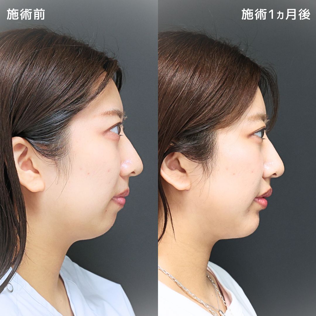 《脂肪吸引》加工アプリ級のスッキリ小顔を手に入れる！