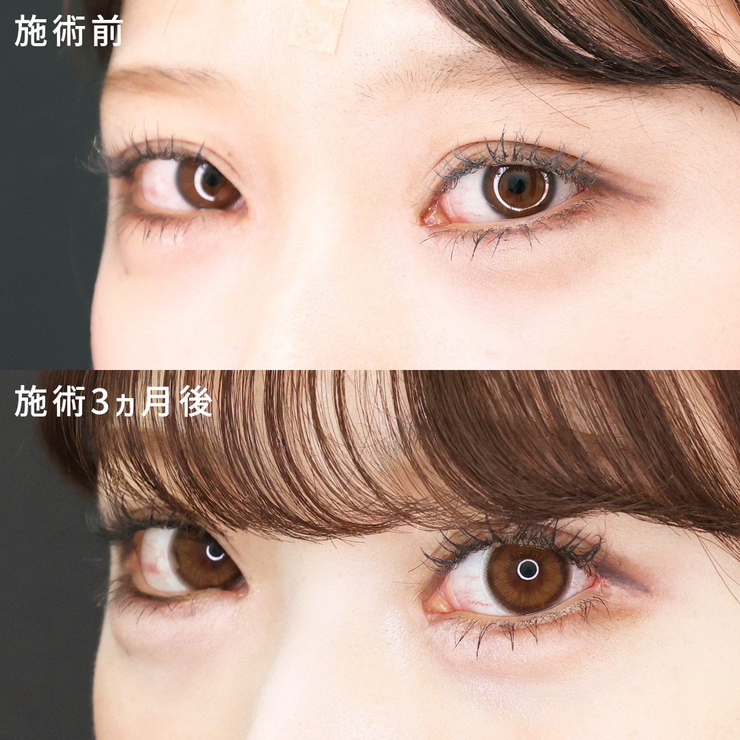 複合目元整形でタレ目で可愛く♡