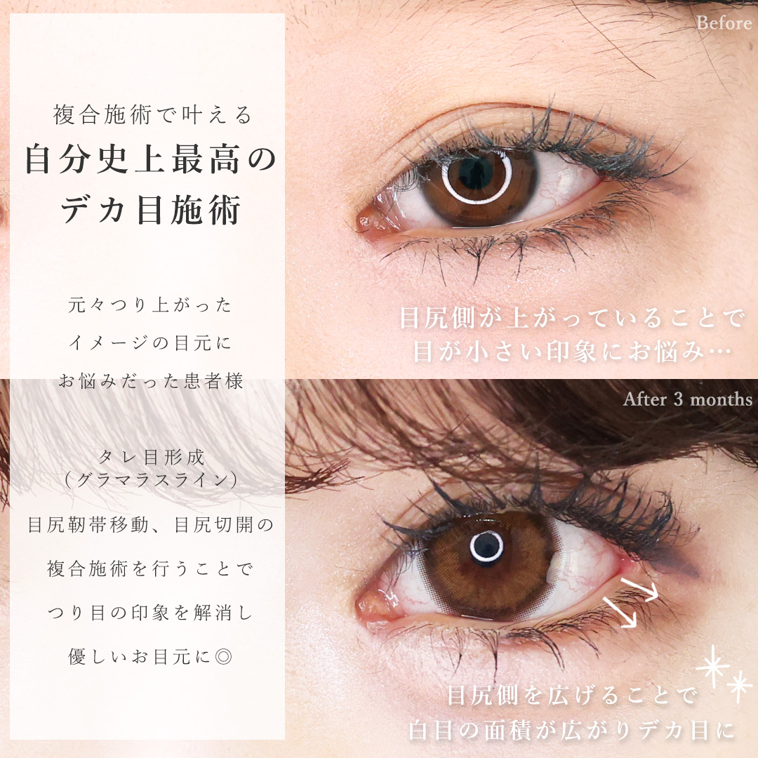 目尻切開術/目尻靭帯移動術/グラマラスライン（タレ目形成）の症例写真 施術前後 