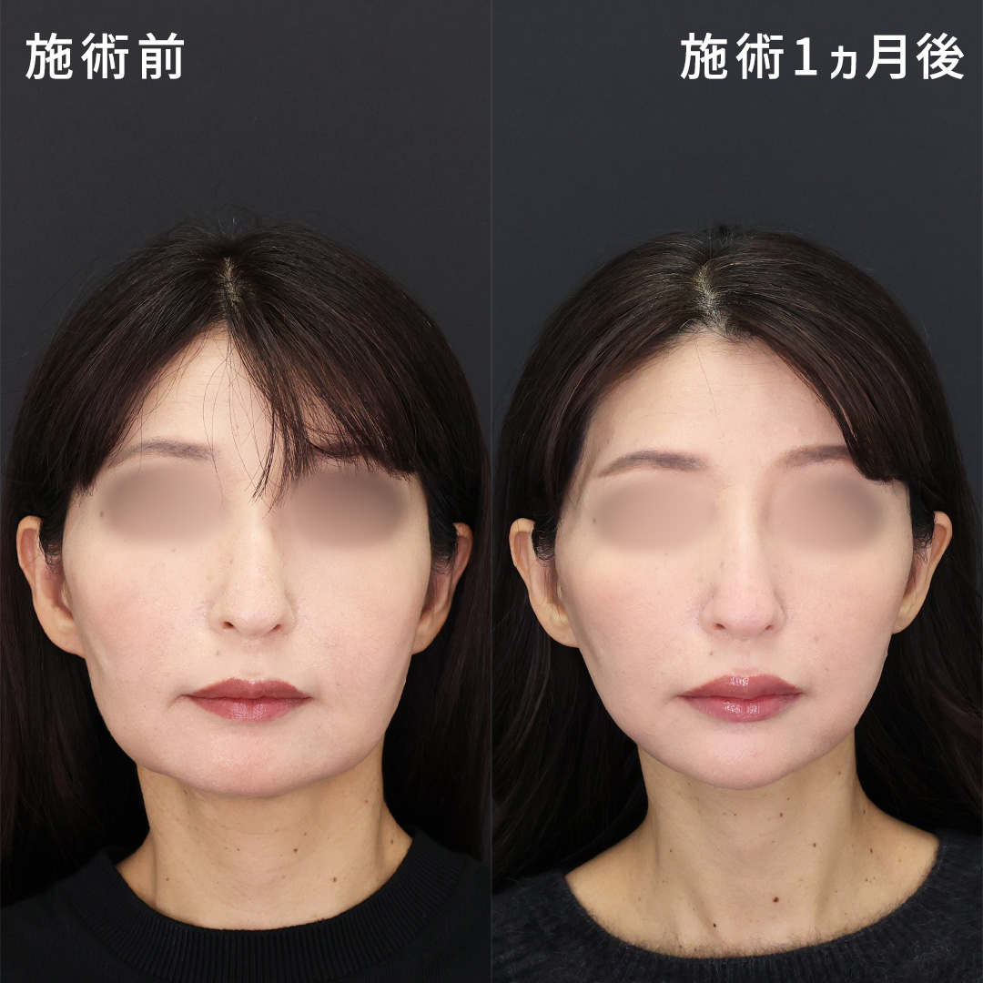 年齢を重ね、四角くなった輪郭を若々しい印象に