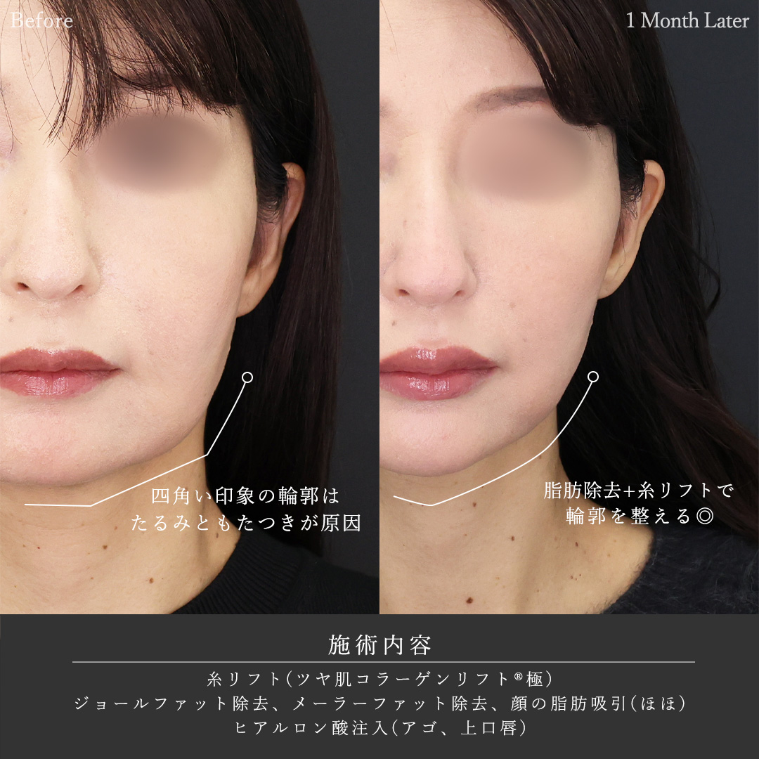 TAC式 ツヤ肌コラーゲンリフト®/ジョールファット除去/メーラーファット除去の症例写真 施術前後 