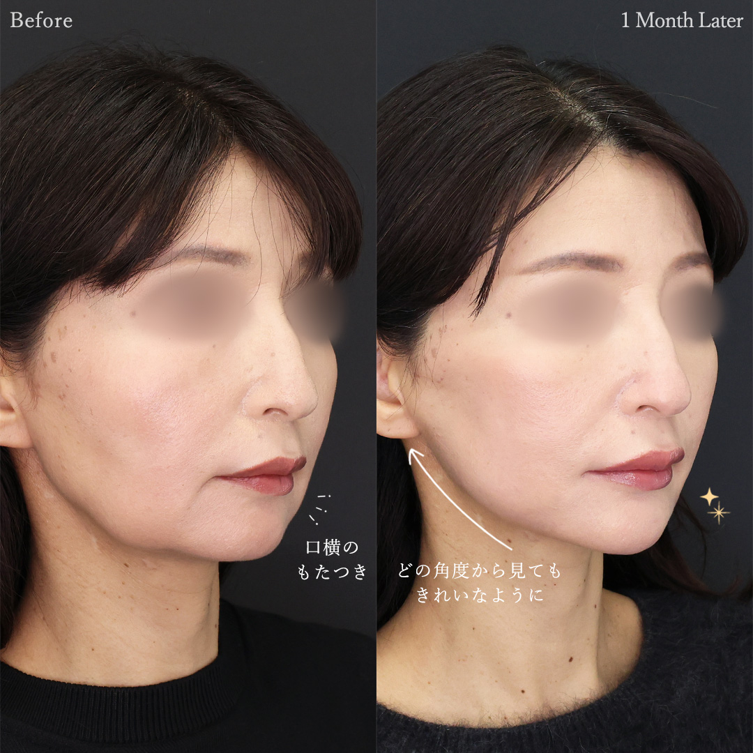 TAC式 ツヤ肌コラーゲンリフト®/ジョールファット除去/メーラーファット除去の症例写真 施術前後 