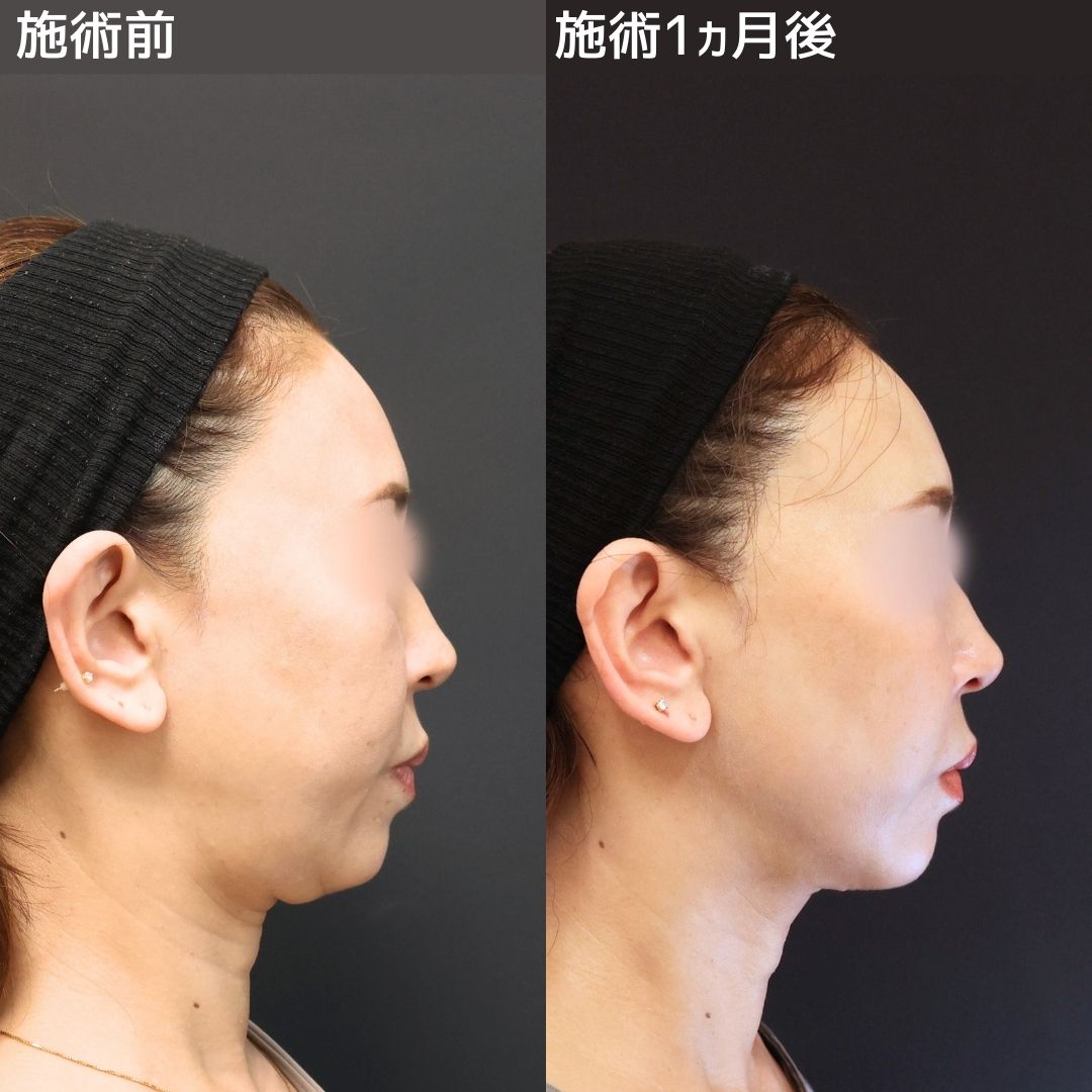 《ペリカン手術》二重アゴ・たるみ解消で本来の美しいフェイスラインに