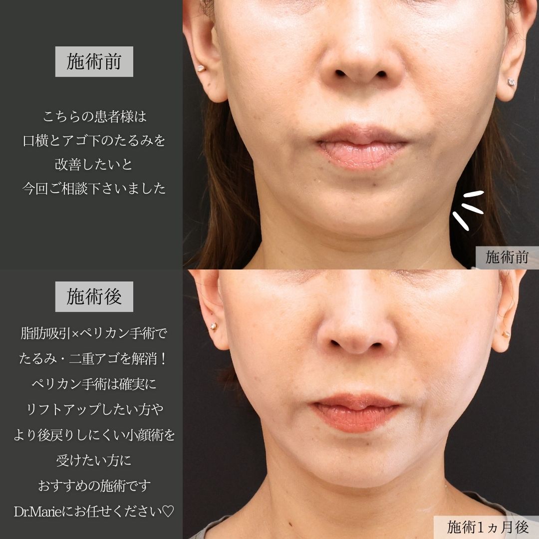 顔の脂肪吸引/TAC式 ツヤ肌コラーゲンリフト®/フェイスリフト（切開）の症例写真 施術前後 