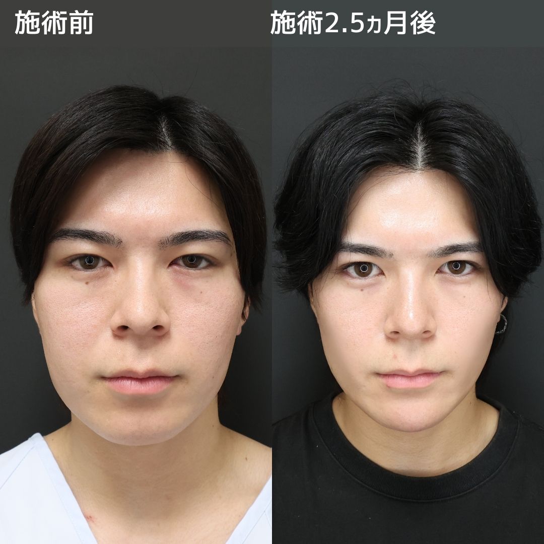 《男性美容》小顔整形で爆モテメンズへ