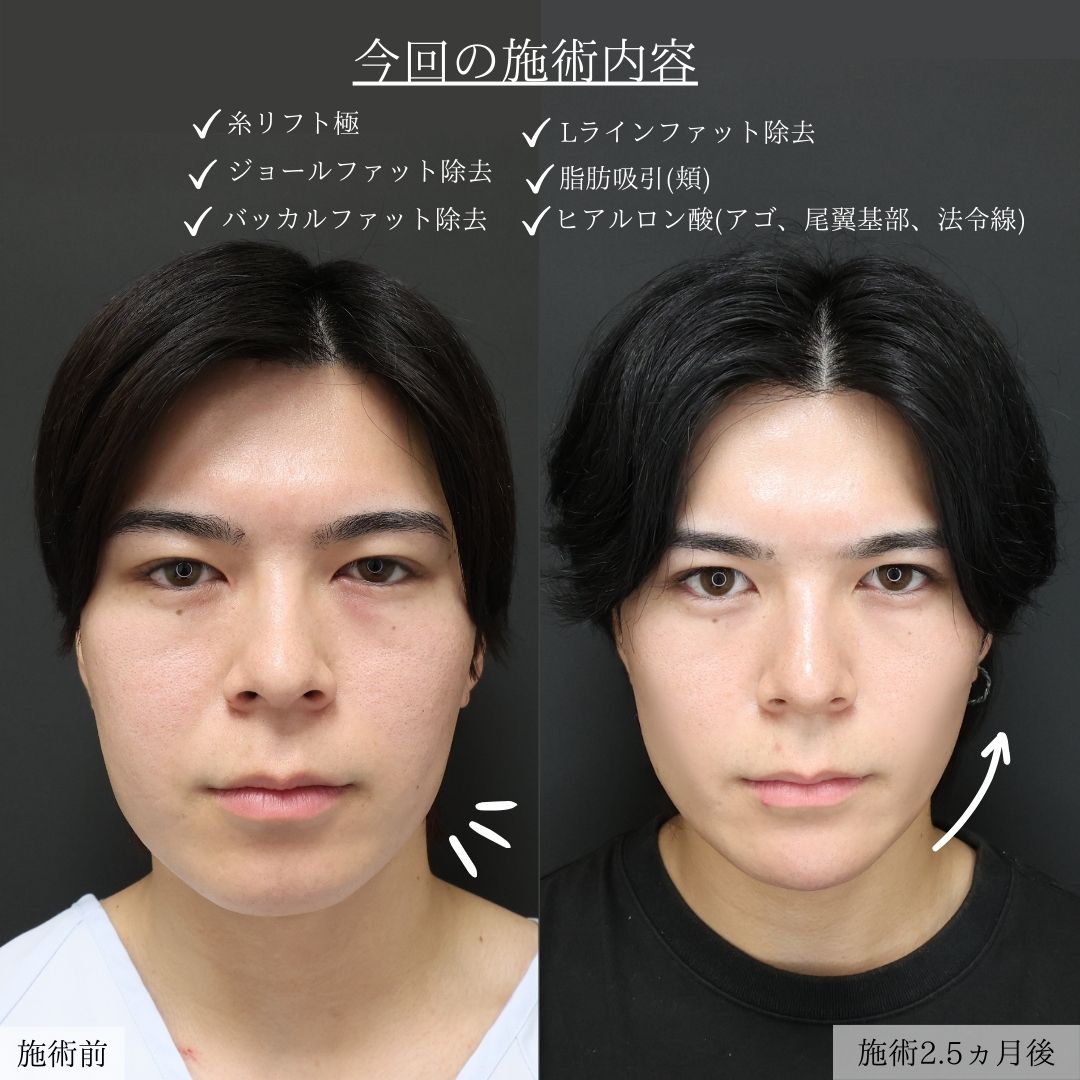 TAC式 ツヤ肌コラーゲンリフト®/バッカルファット除去/ジョールファット除去の症例写真 施術前後 