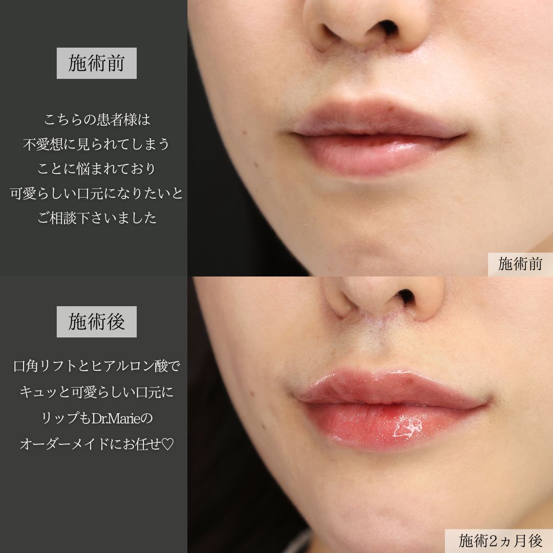 口角挙上・リフト（マイクロ切開法・内側法/口内法）の症例写真 施術前後 