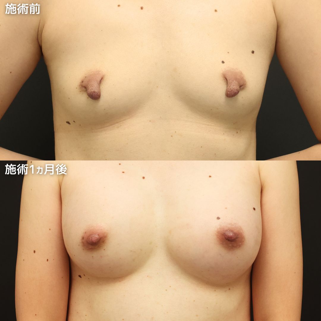 《乳頭縮小術》で垂れ下がった乳頭を綺麗に整える