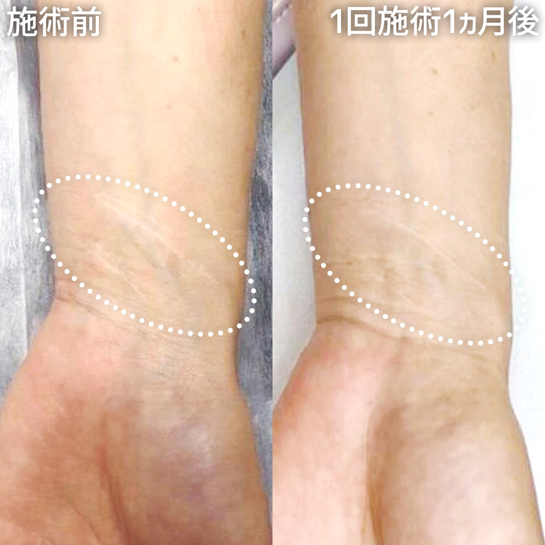 アートメイクSkin52（妊娠線・肉割れ・ストレッチマーク・リスカ跡・傷跡修正）の症例写真 施術前後 