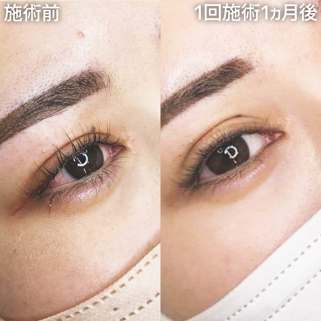 【Skin52】結婚式に向けて、目頭切開の傷跡をアートメイクで目立ちにくく