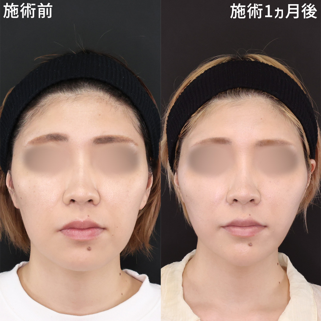 糸リフトで輪郭のもたつきスッキリ！