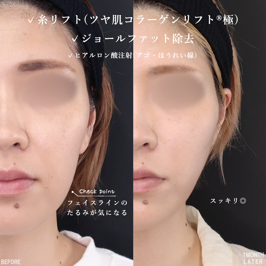 TAC式 ツヤ肌コラーゲンリフト®/ジョールファット除去/ほうれい線のヒアルロン酸注射の症例写真 施術前後 