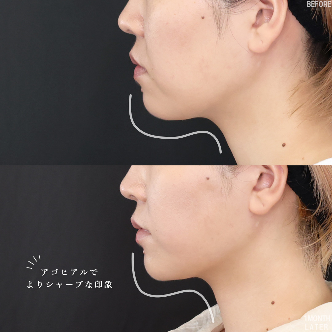 TAC式 ツヤ肌コラーゲンリフト®/ジョールファット除去/ほうれい線のヒアルロン酸注射の症例写真 施術前後 