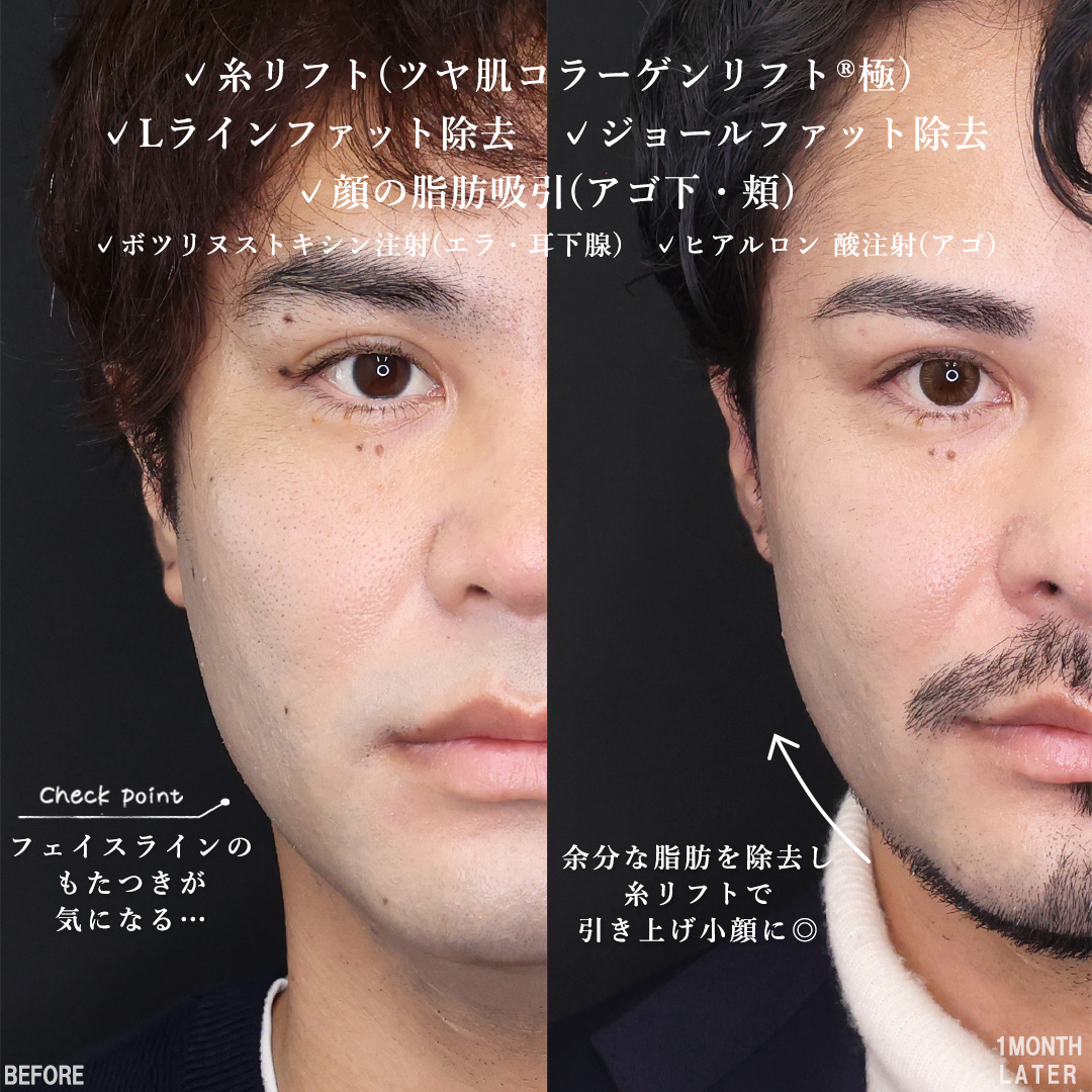 TAC式 ツヤ肌コラーゲンリフト®/Lラインファット除去（エラ下脂肪除去）/ジョールファット除去の症例写真 施術前後 