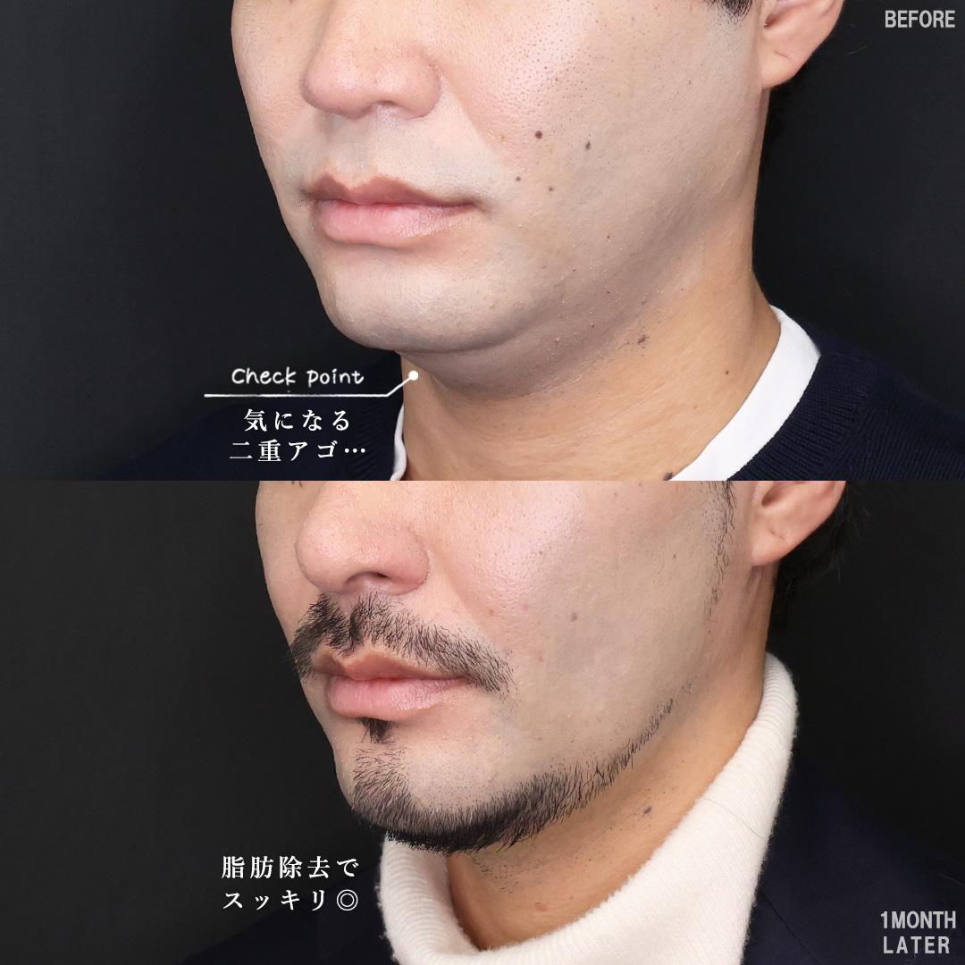 TAC式 ツヤ肌コラーゲンリフト®/Lラインファット除去（エラ下脂肪除去）/ジョールファット除去の症例写真 施術前後 