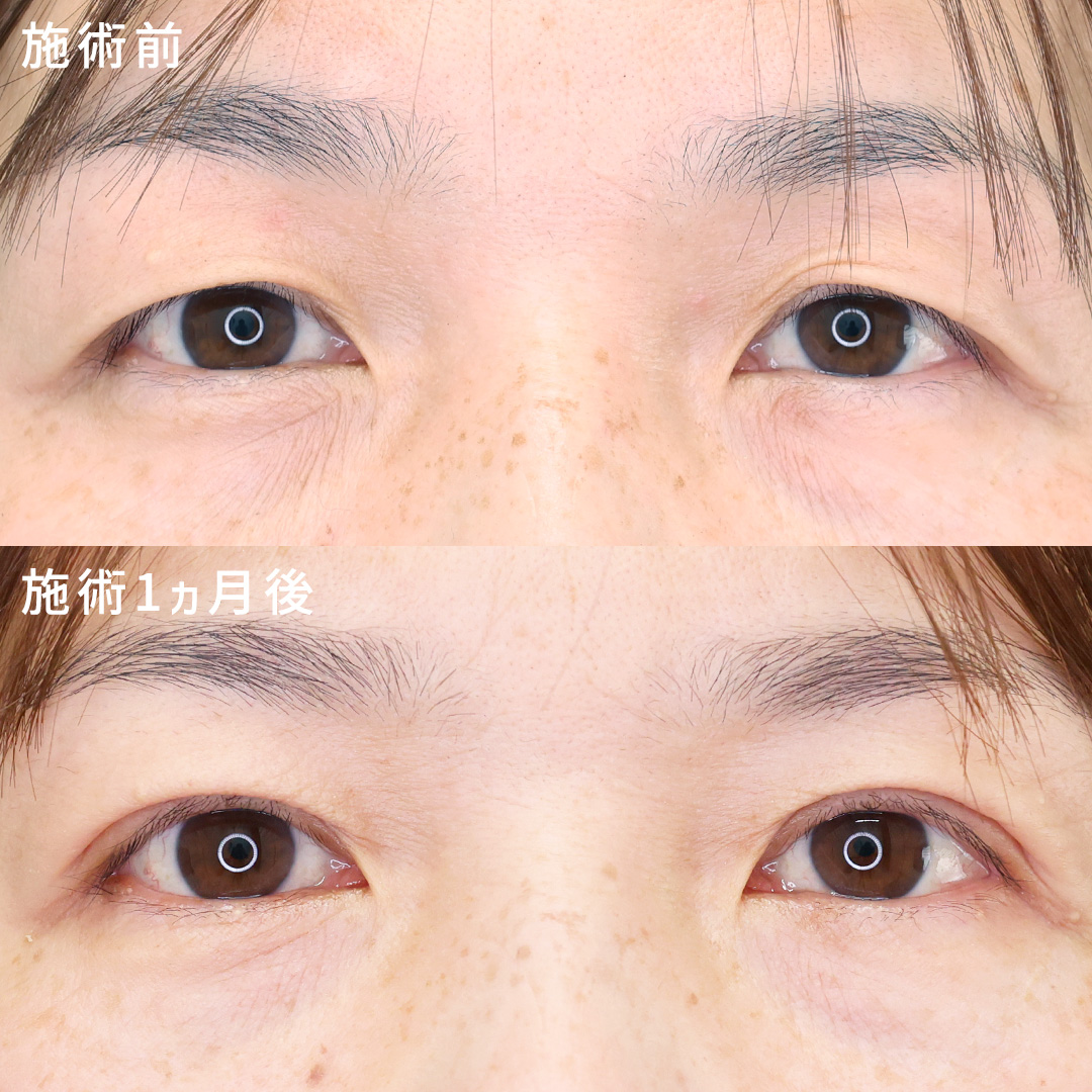 ４０代の二重埋没法