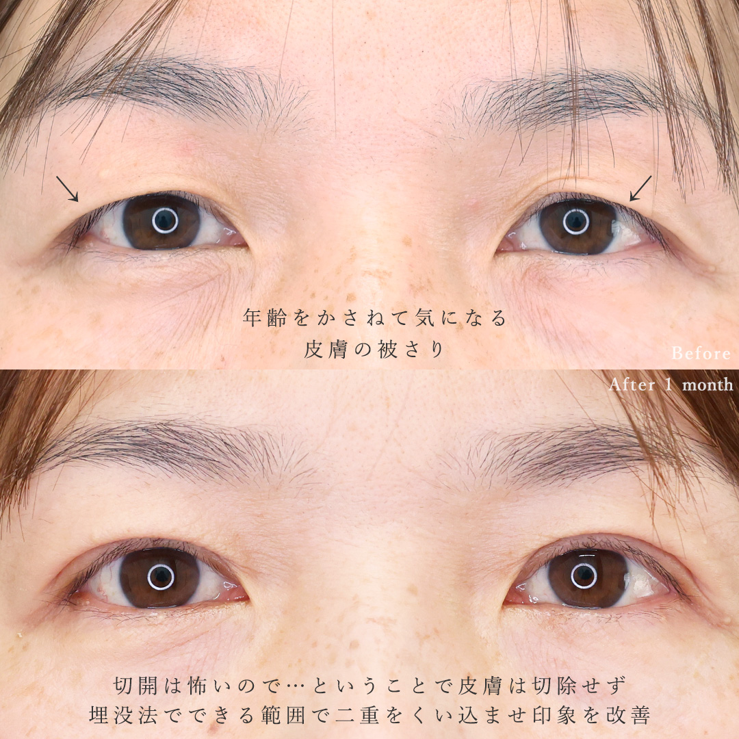 二重埋没法の症例写真 施術前後 