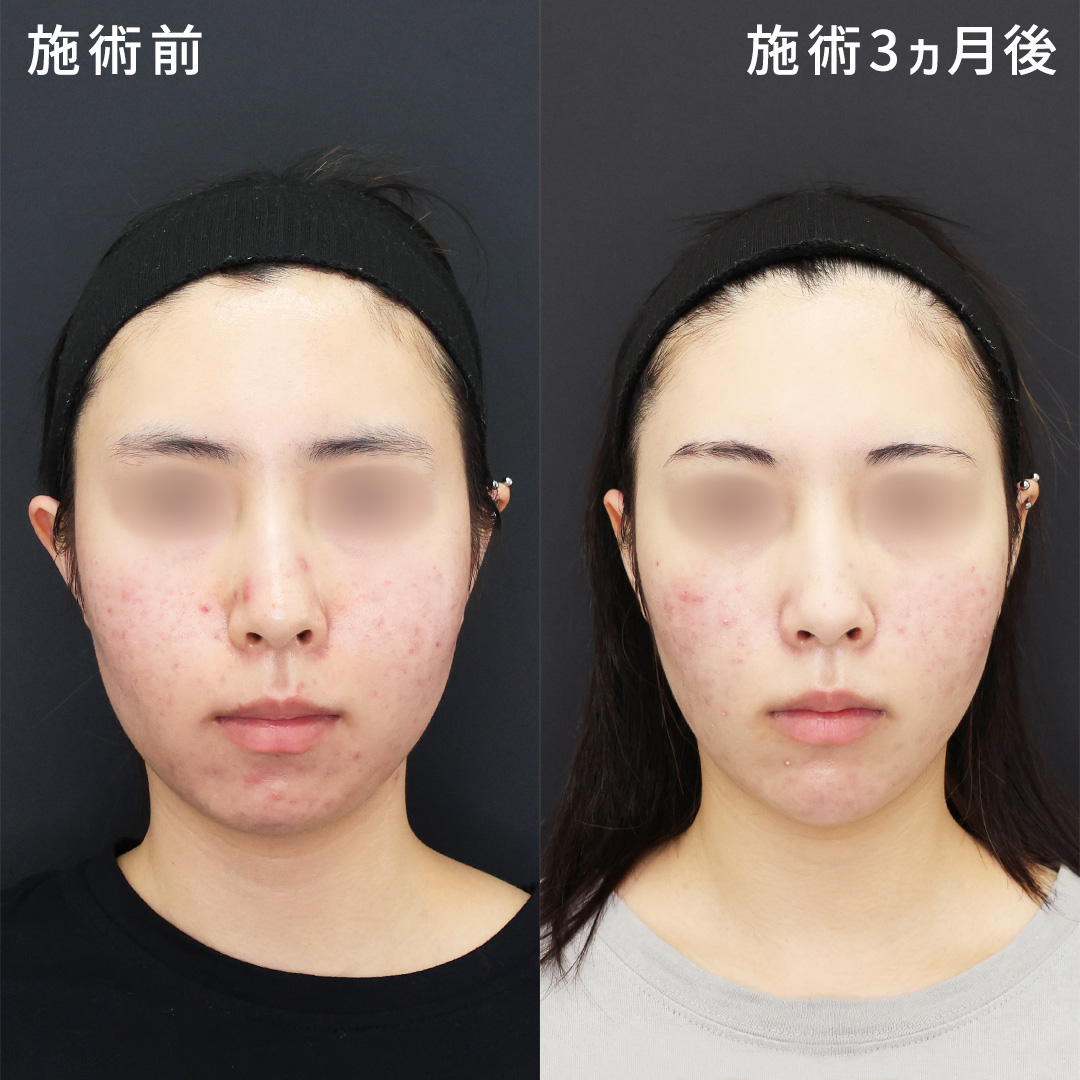 頬のもたつきを改善し、憧れのフェイスラインに