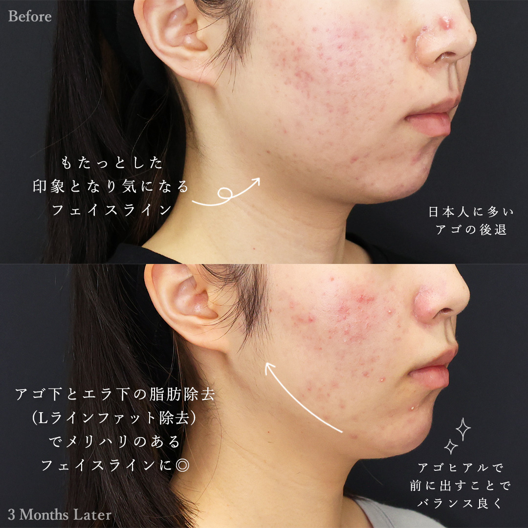 TAC式 ツヤ肌コラーゲンリフト®/メーラーファット除去/Lラインファット除去（エラ下脂肪除去）の症例写真 施術前後 