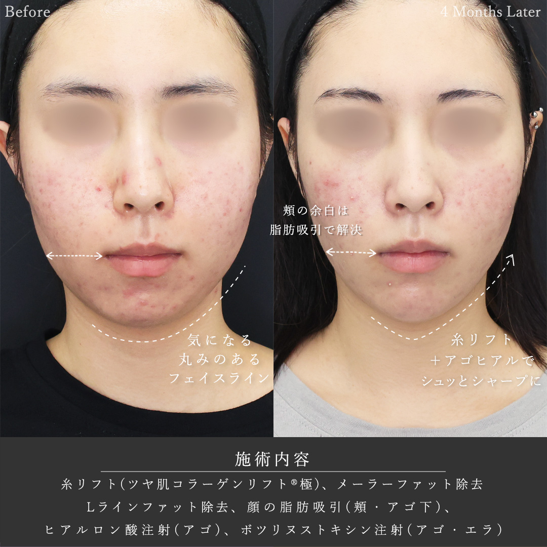 TAC式 ツヤ肌コラーゲンリフト®/メーラーファット除去/Lラインファット除去（エラ下脂肪除去）の症例写真 施術前後 