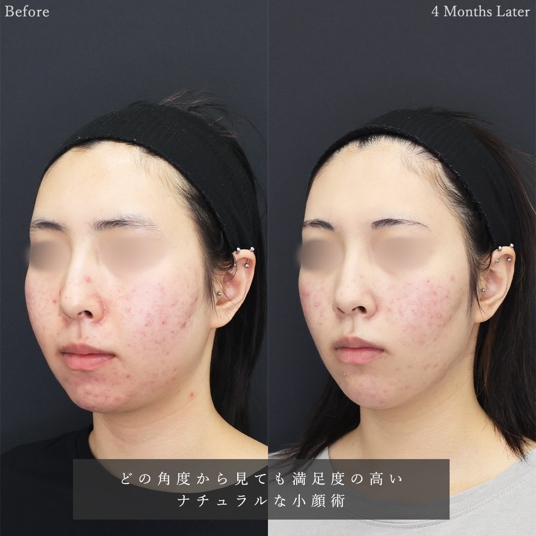 TAC式 ツヤ肌コラーゲンリフト®/メーラーファット除去/Lラインファット除去（エラ下脂肪除去）の症例写真 施術前後 