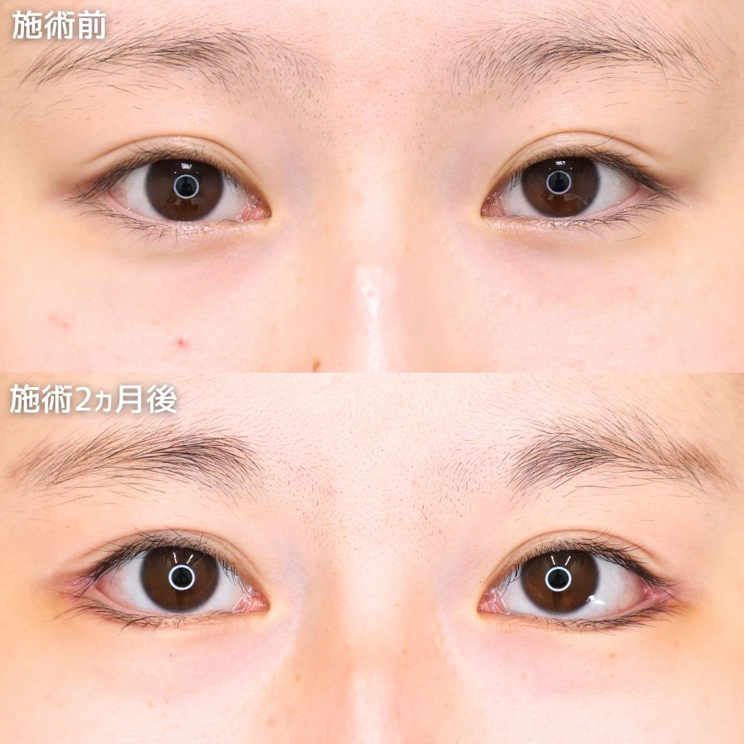 《形成外科専門医》Dr.藤橋のタレ目形成