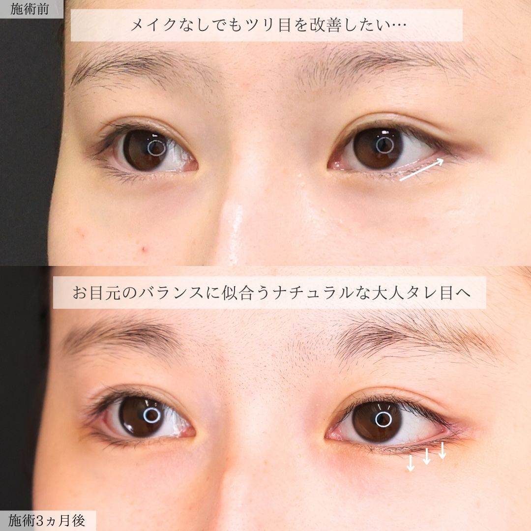 グラマラスライン（タレ目形成）/目尻靭帯移動術の症例写真 施術前後 