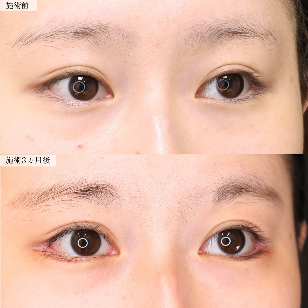 グラマラスライン（タレ目形成）/目尻靭帯移動術の症例写真 施術前後 