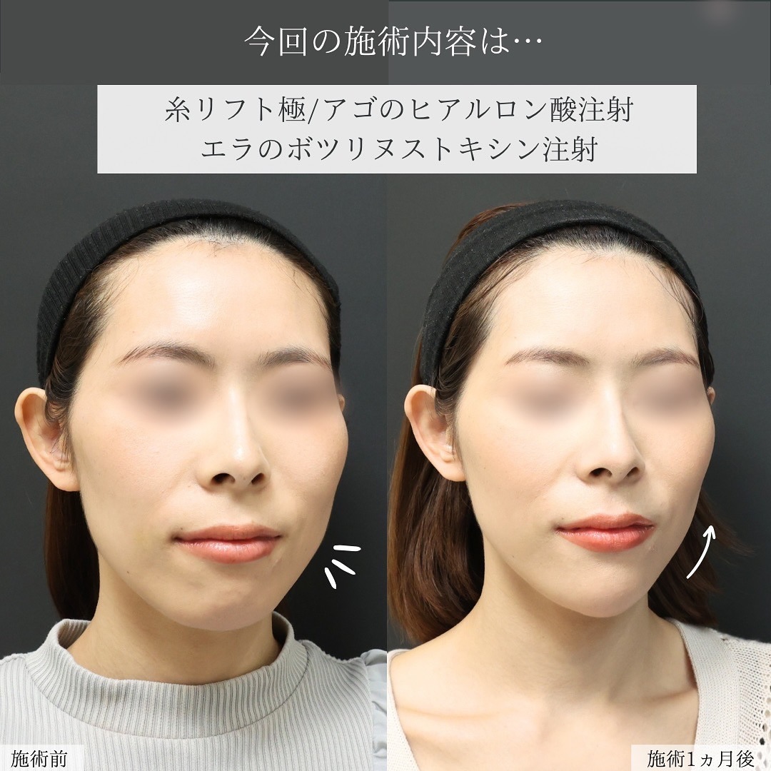 TAC式 ツヤ肌コラーゲンリフト®/顎のヒアルロン酸注射/エラボトックス注射の症例写真 施術前後