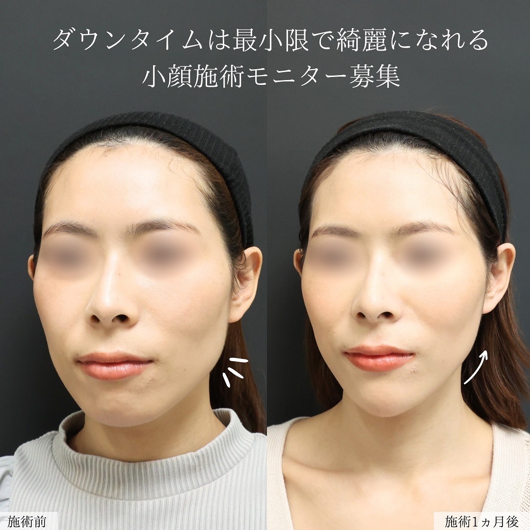 TAC式 ツヤ肌コラーゲンリフト®/顎のヒアルロン酸注射/エラボトックス注射の症例写真 施術前後