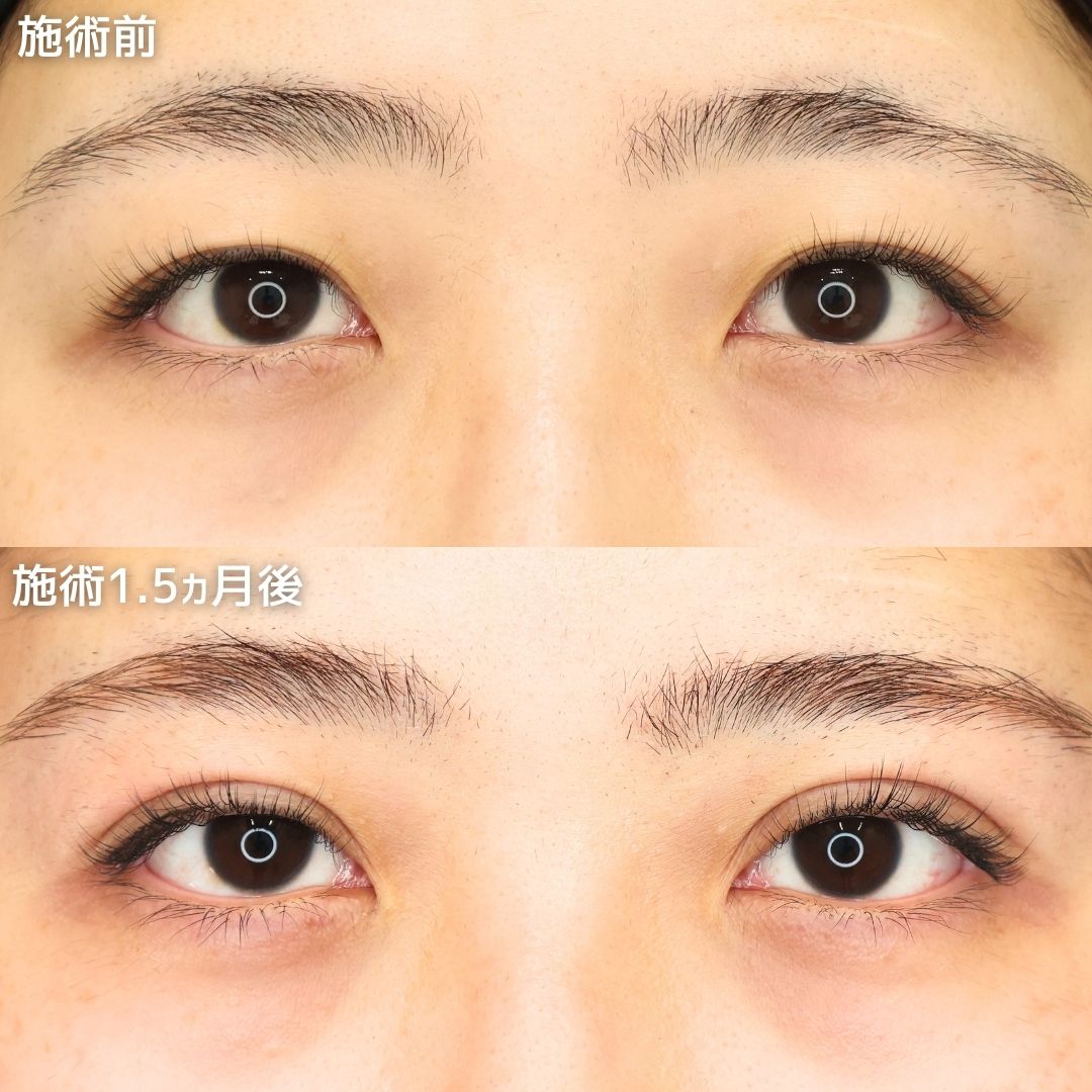 《埋没法でもっと可愛く》元々の二重幅を広げてイメチェン