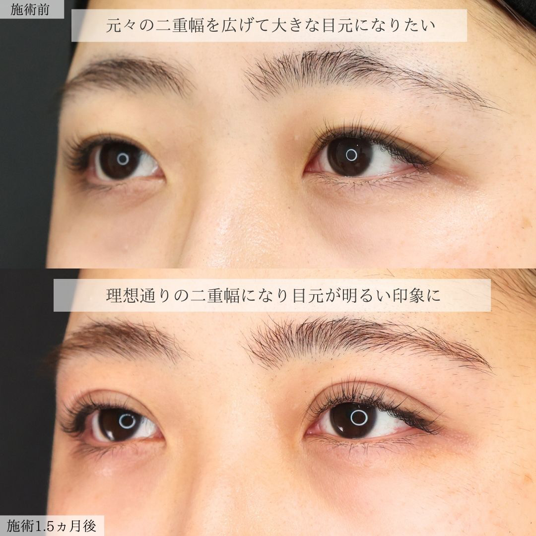 二重埋没法の症例写真 施術前後 