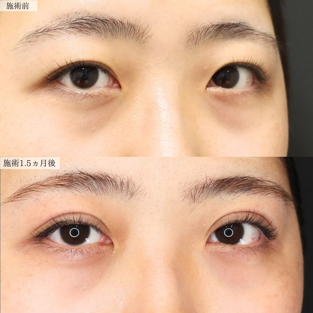 二重埋没法の症例写真 施術前後 