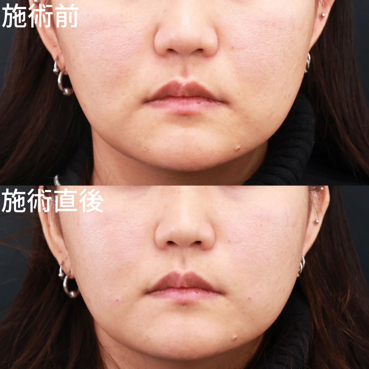 【法令線ヒアルロン酸】施術直後から若返る！