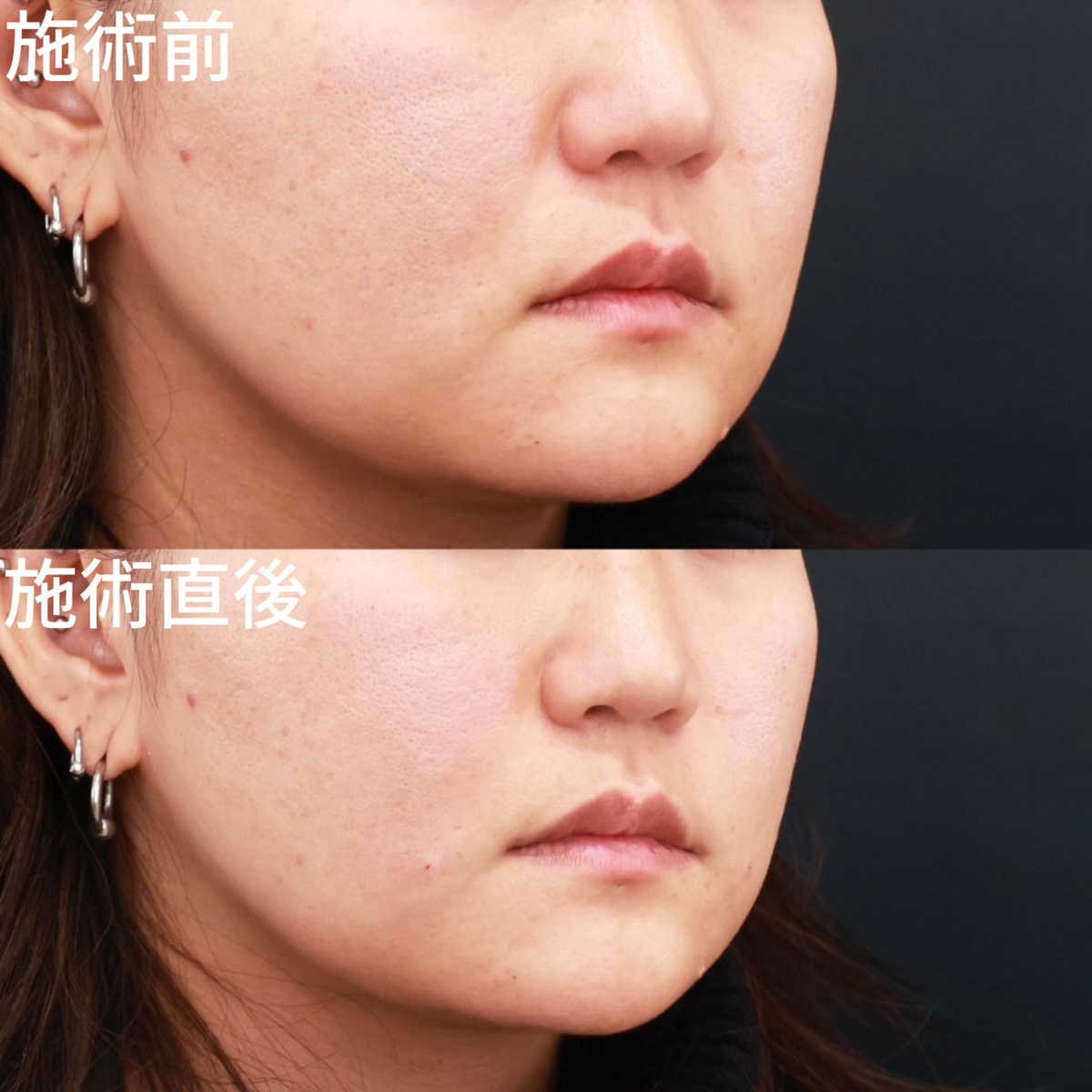 ほうれい線のヒアルロン酸注射の症例写真 施術前後 