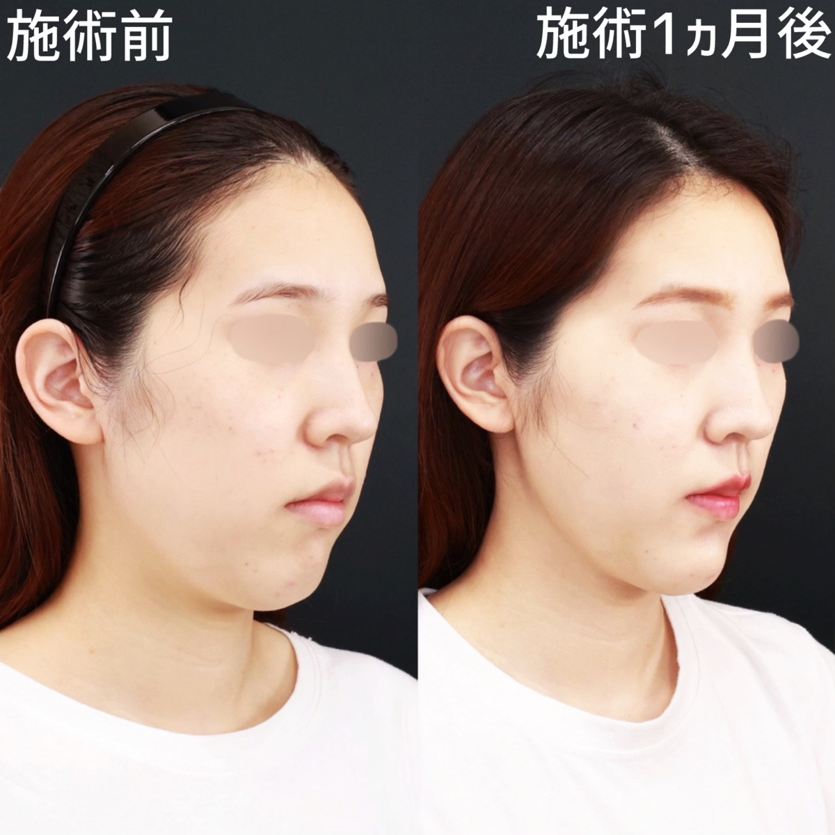 【糸リフト極×顎下脂肪吸引】クッキリと影が出るほど、美しいフェイスラインに！