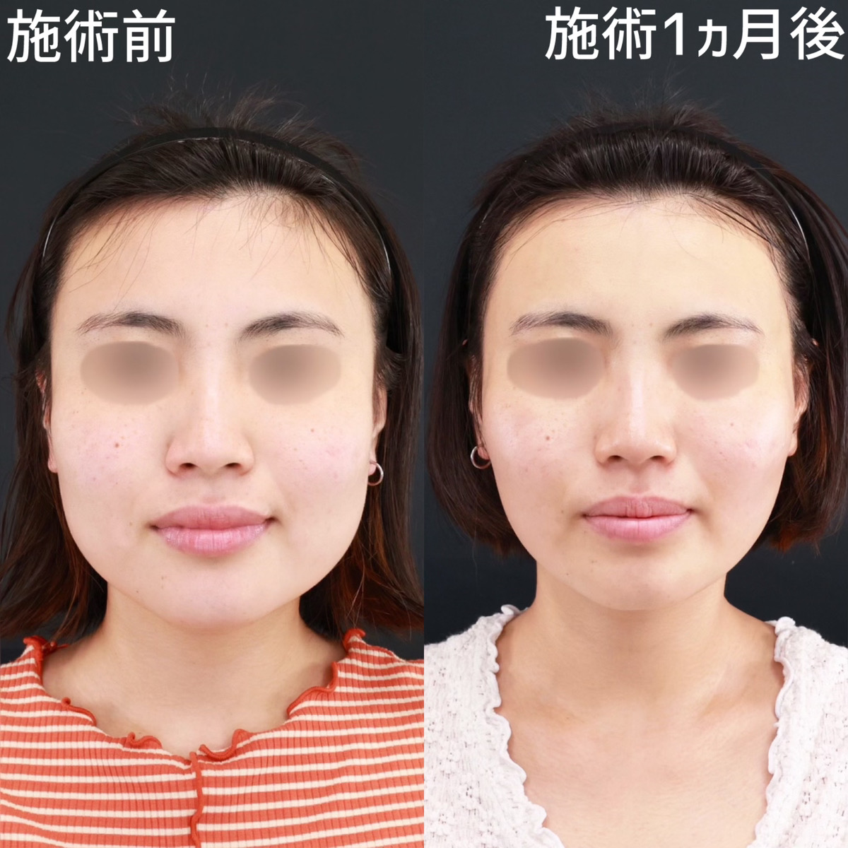 顔の美容外科手術 顔の美容外科手術 ZX-CLINIC【公式】｜大阪梅田・北新地からすぐの
