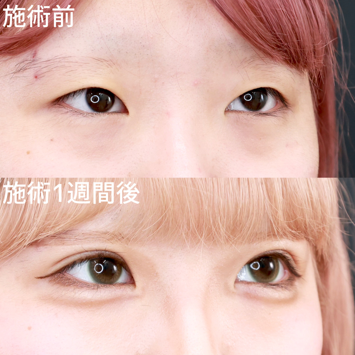 クイックコスメリング/涙袋形成（ヒアルロン酸注射）の症例写真 施術前後 