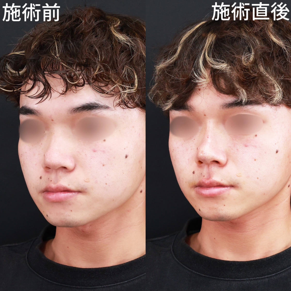 ヴィーナスノーズ(切らない鼻中隔延長術)/鼻のヒアルロン酸注射の症例写真 施術前後