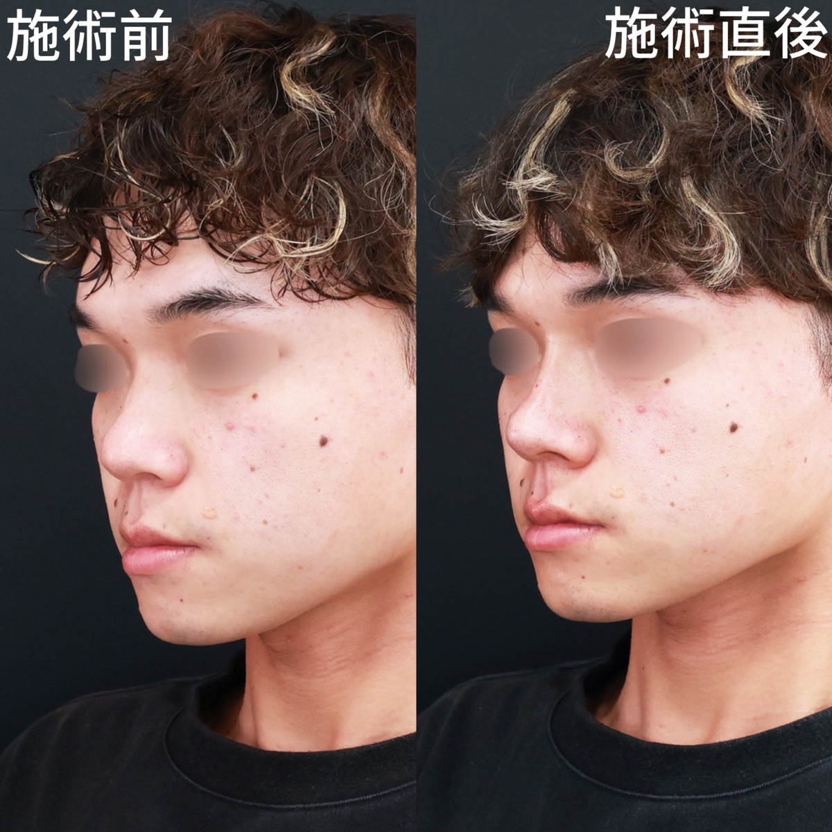 ヴィーナスノーズ(切らない鼻中隔延長術)/鼻のヒアルロン酸注射の症例写真 施術前後