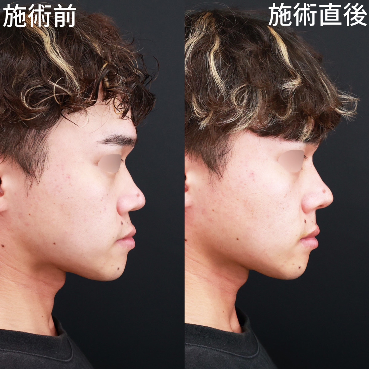 ヴィーナスノーズ(切らない鼻中隔延長術)/鼻のヒアルロン酸注射の症例写真 施術前後