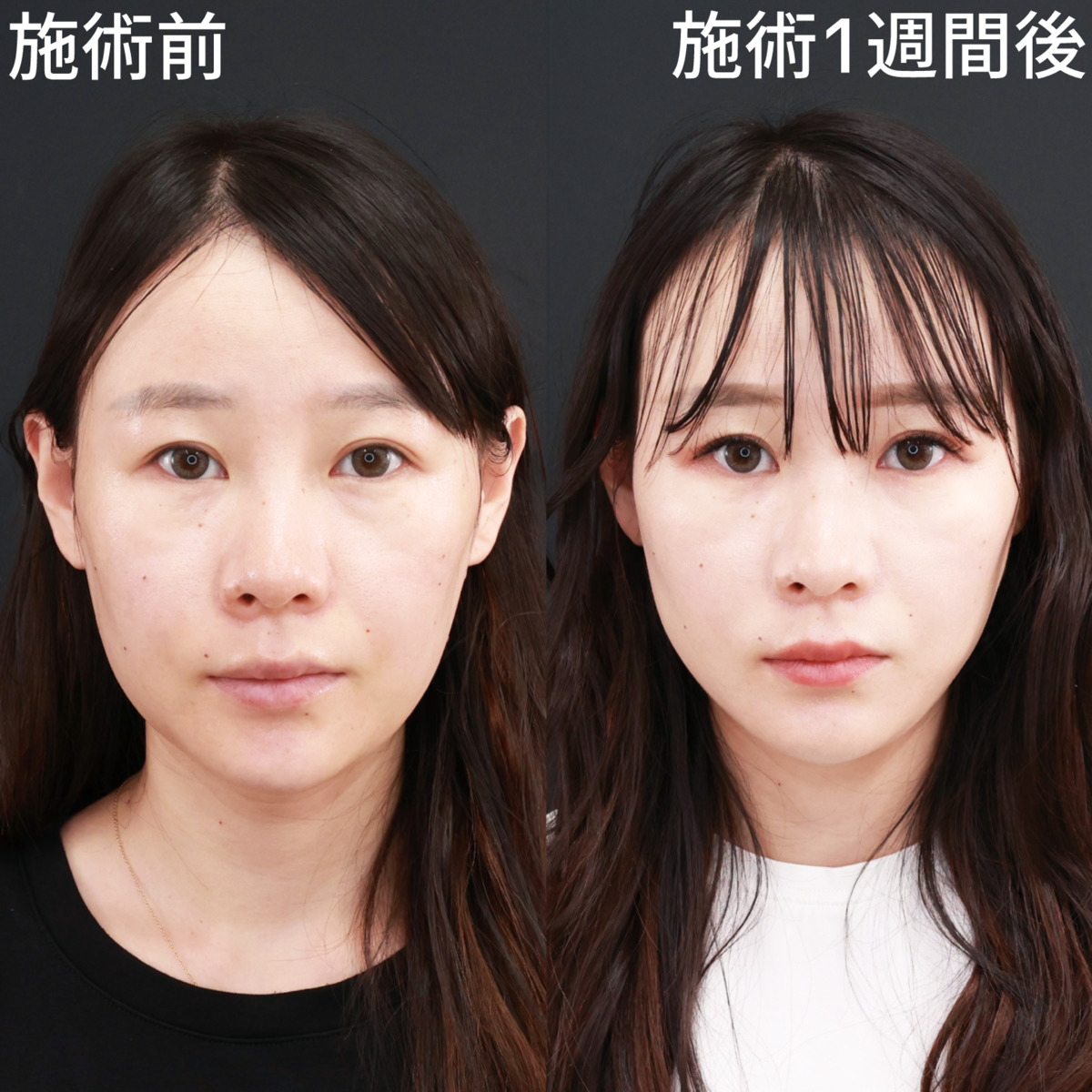 【糸リフト極】リフトアップで即効若返り！