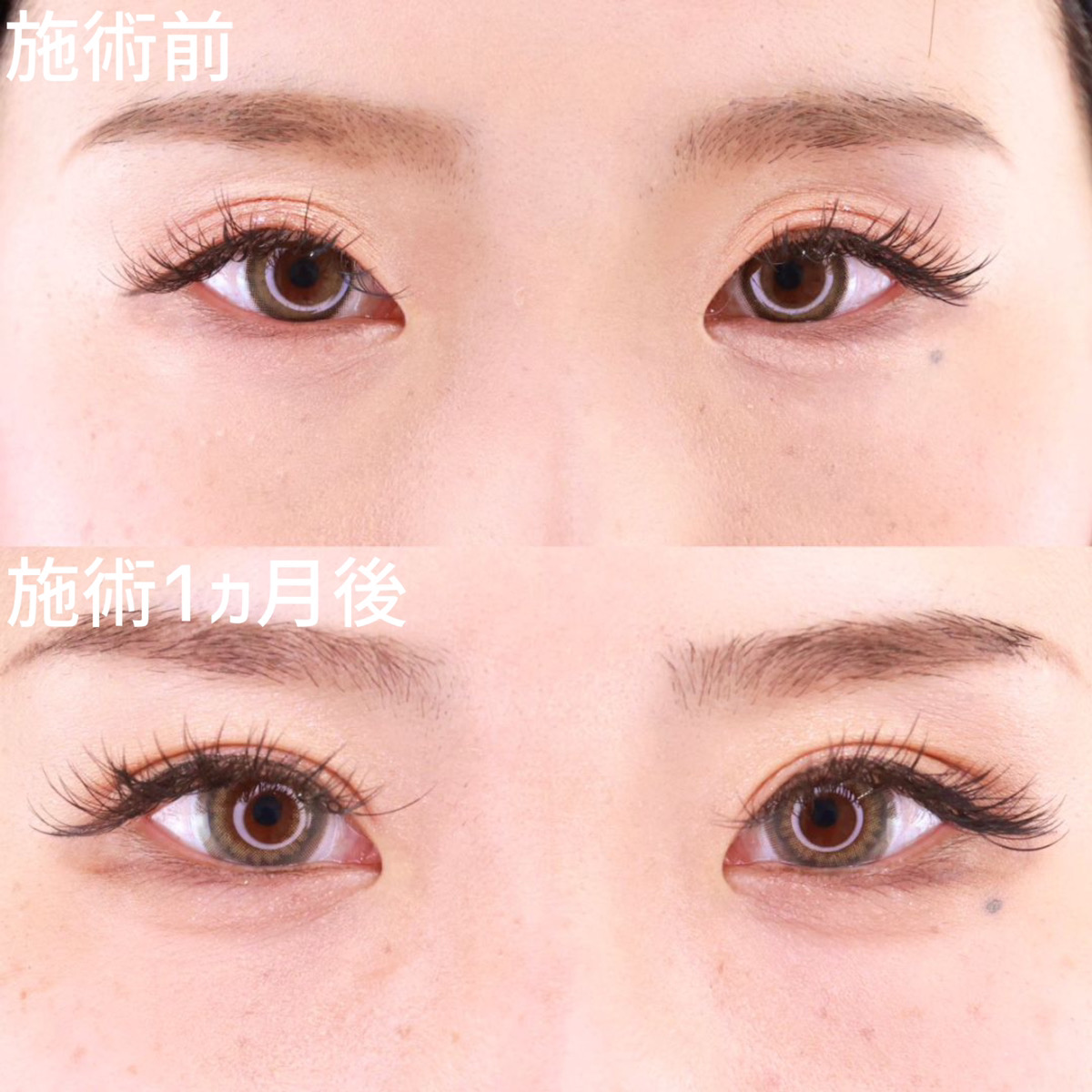 【二重埋没法】左右差のないクッキリ安定した二重に！