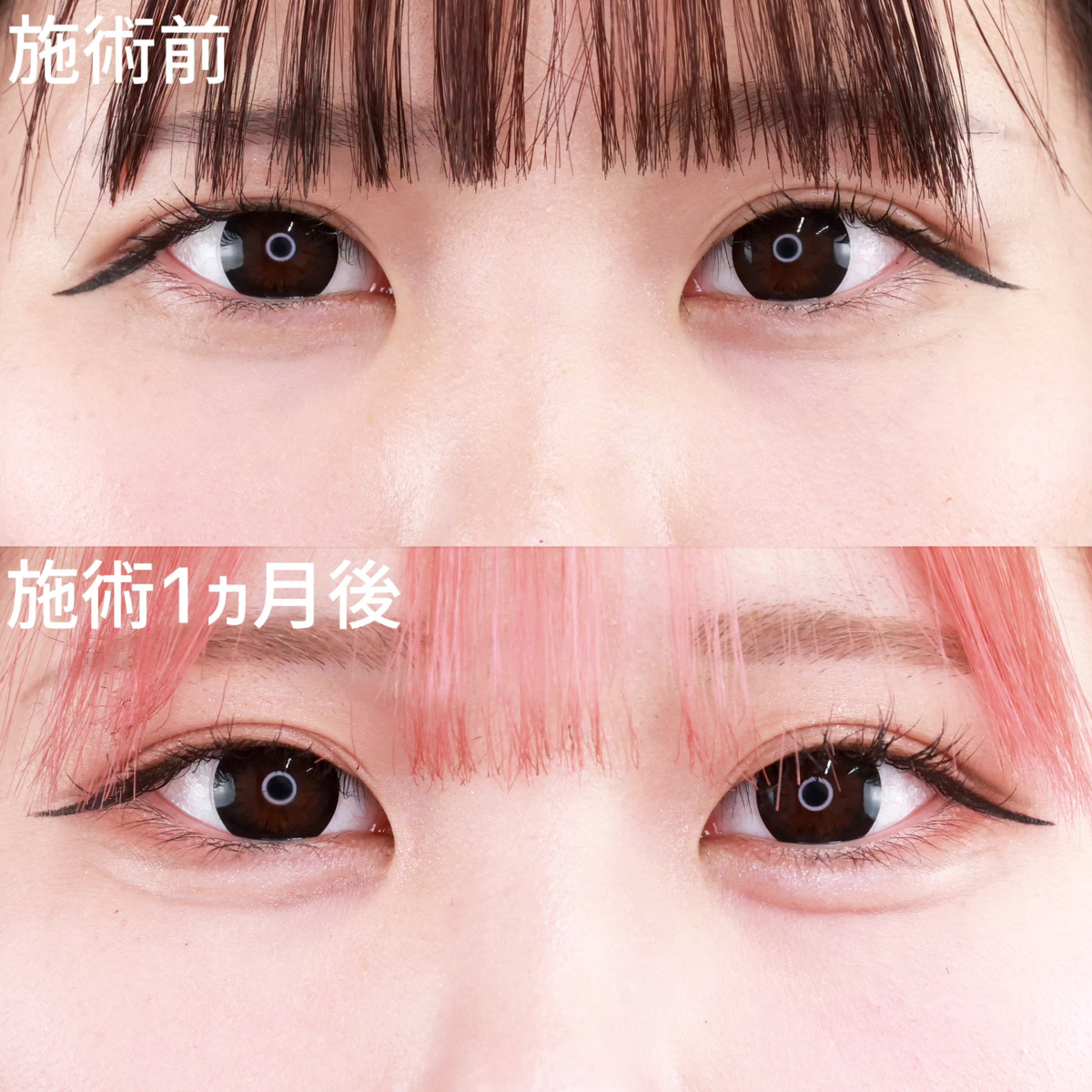 【涙袋ヒアルロン酸】ぷっくりと可愛らしい目元に◎