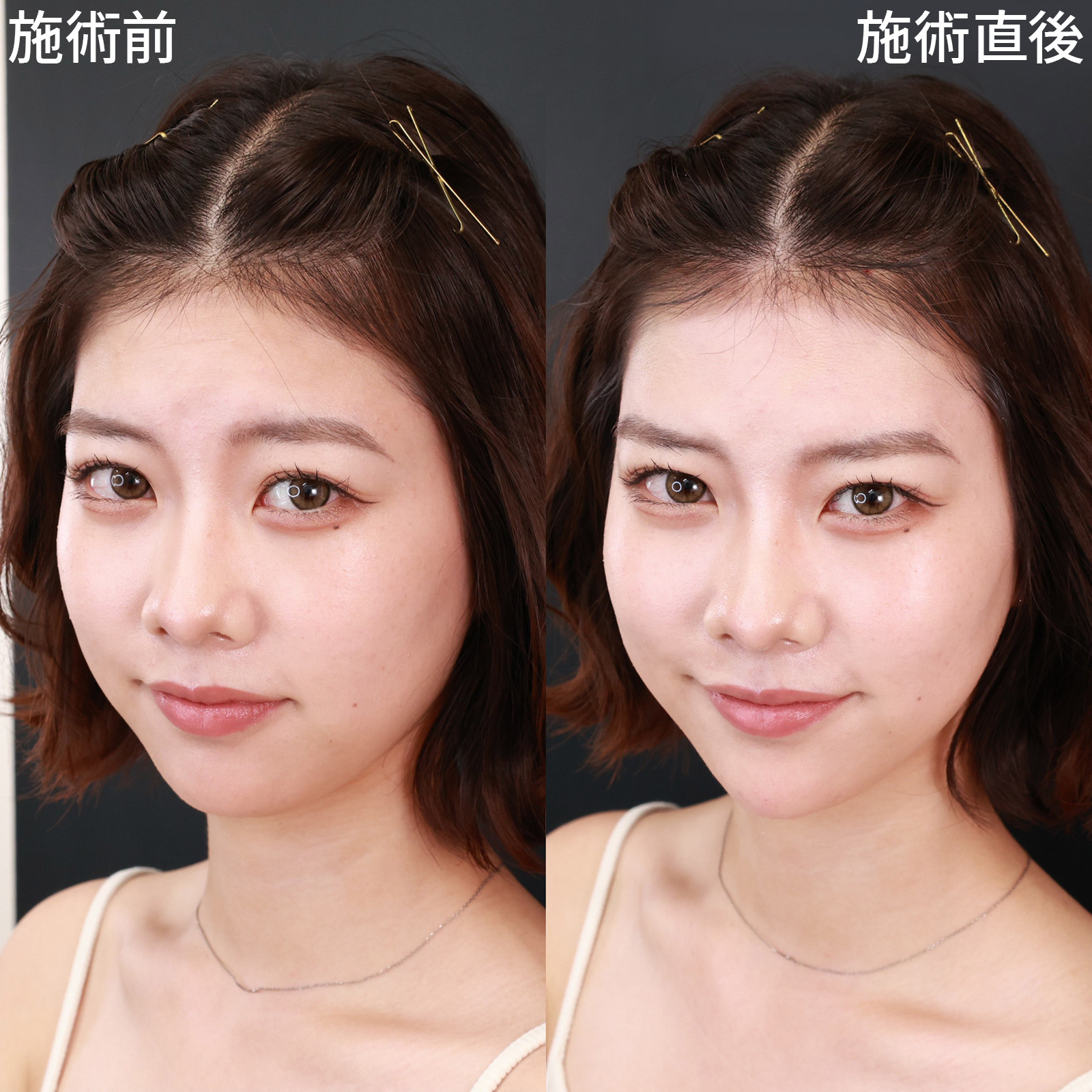 顎のヒアルロン酸注射の症例写真 施術前後 