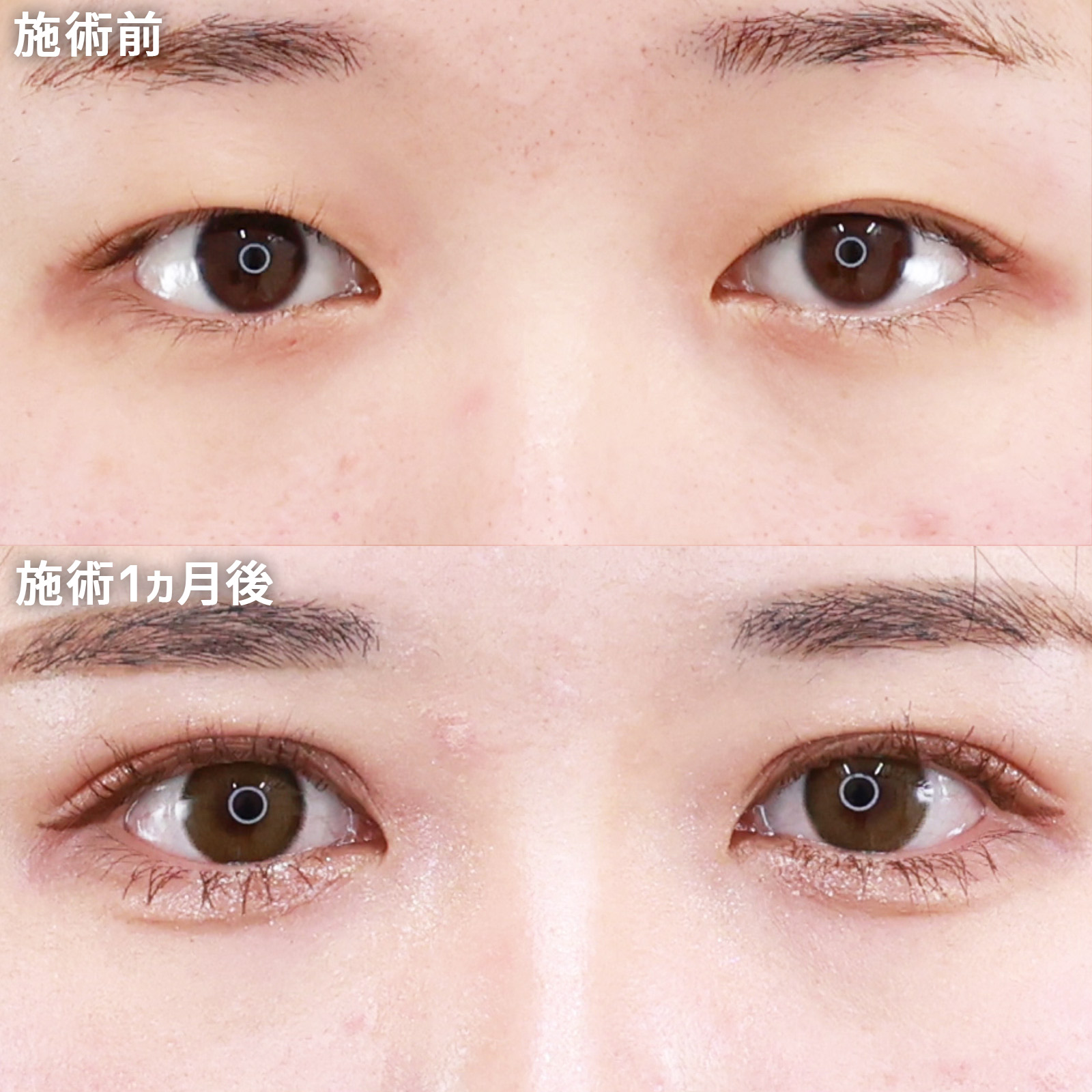 【二重埋没法】ナチュラルな変化でも、確実に可愛く！