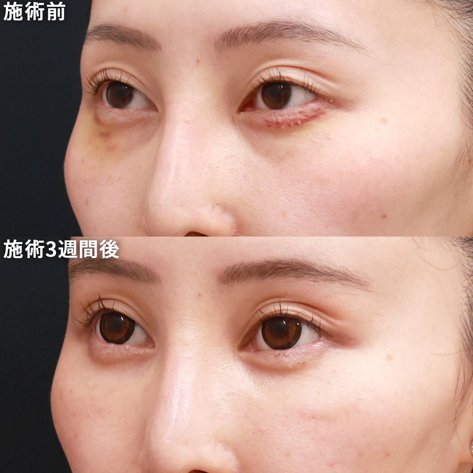 下眼瞼脱脂術（目の下のたるみ取り・目の下の脂肪ふくらみ取り）/顔の脂肪注入(コンデンスリッチフェイス)の症例写真 施術前後 