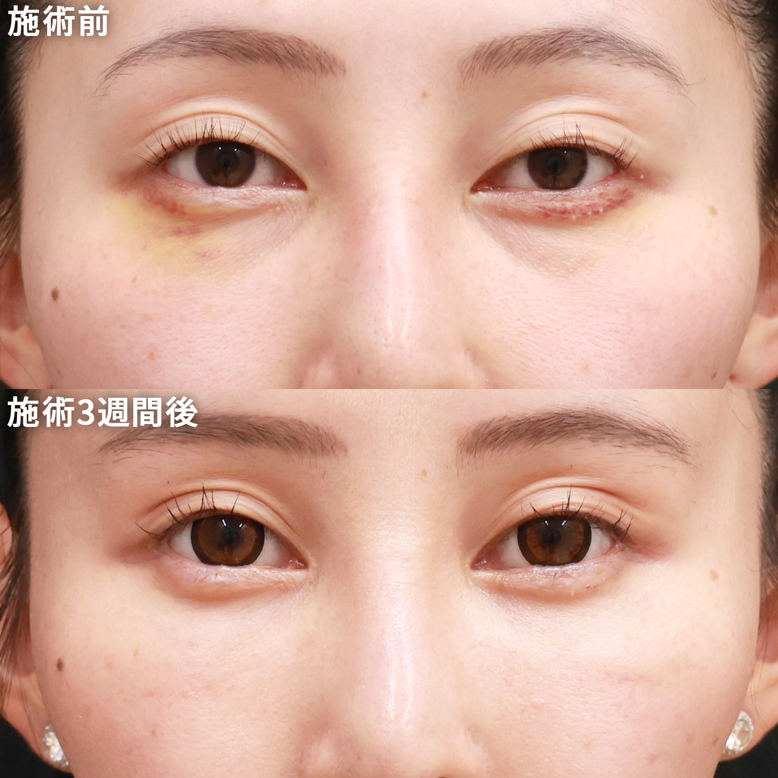 【下眼瞼脱脂術＆脂肪注入】目の下の膨らみを無くし、ハリのある若々しい目元に