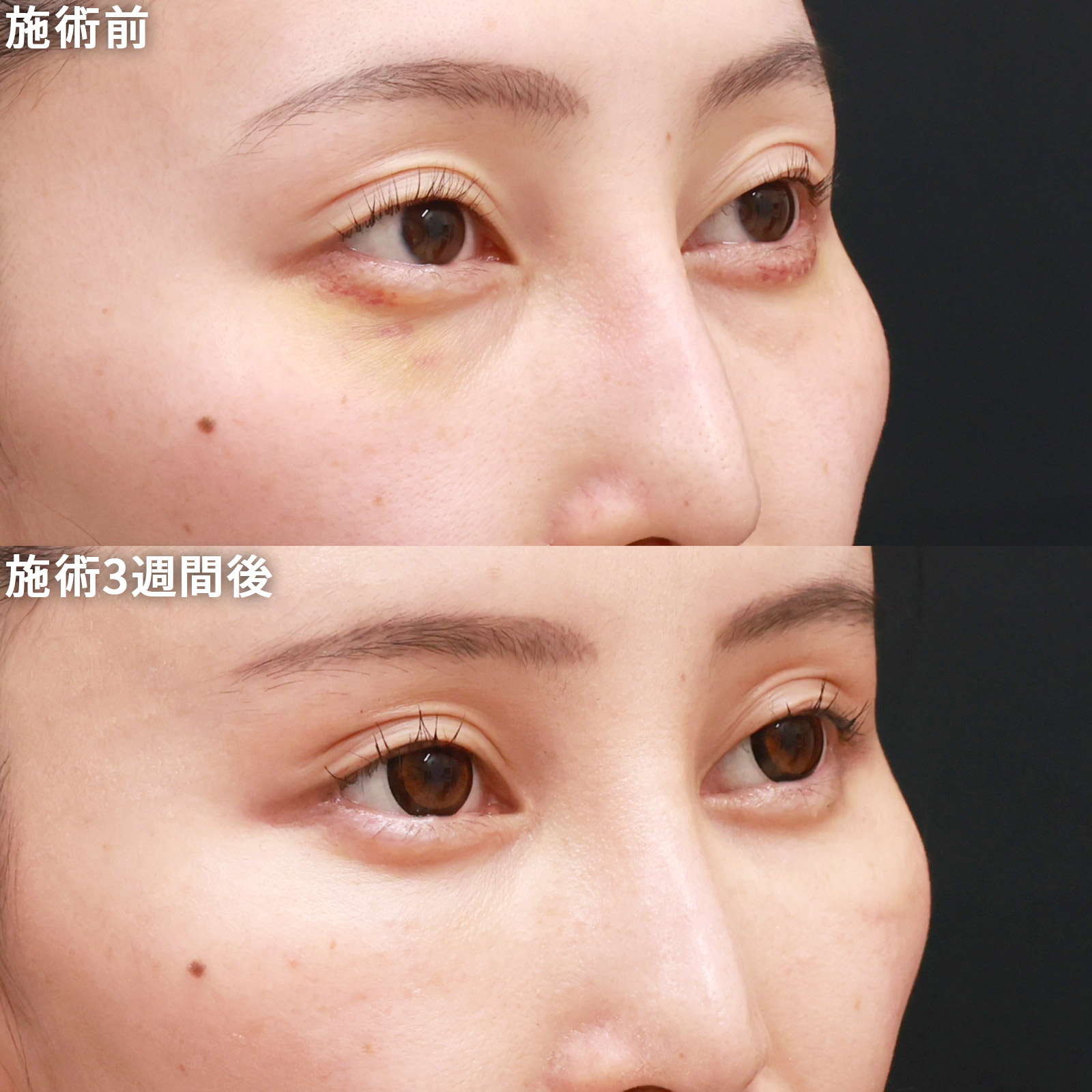 下眼瞼脱脂術（目の下のたるみ取り・目の下の脂肪ふくらみ取り）/顔の脂肪注入(コンデンスリッチフェイス)の症例写真 施術前後 